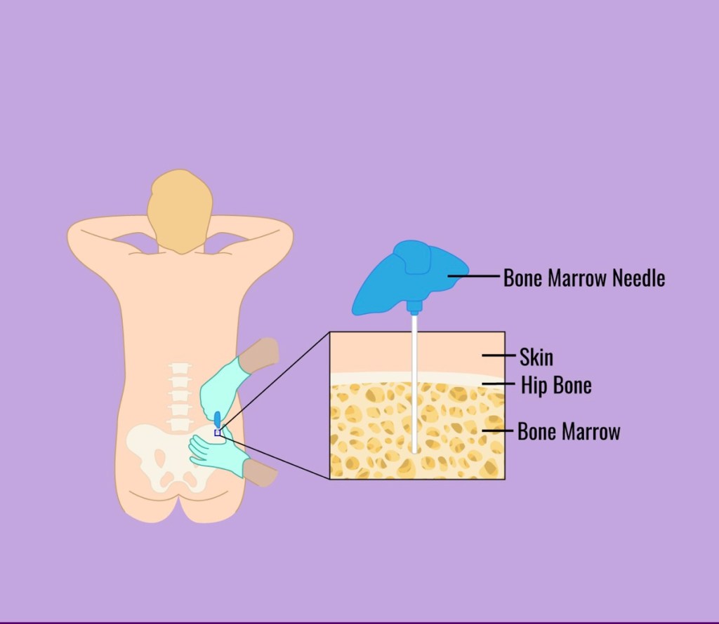 Bone Marrow Biopsy&nbsp;#3