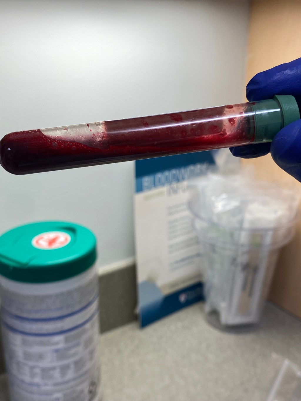 Bone Marrow Biopsy&nbsp;#6